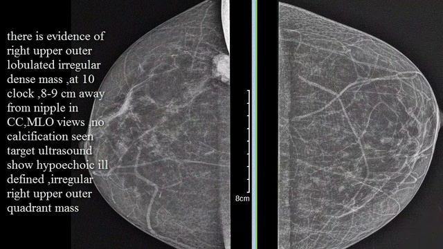 CASE 169 SONOMAMMOGRAPHY RIGHT CANCER BREAST BIRAD 5