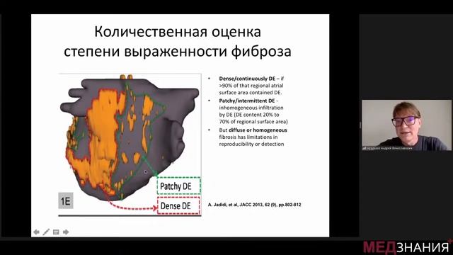 Современный взгляд на клинико-физиологические основы ФП. Новые европейские рекомендации