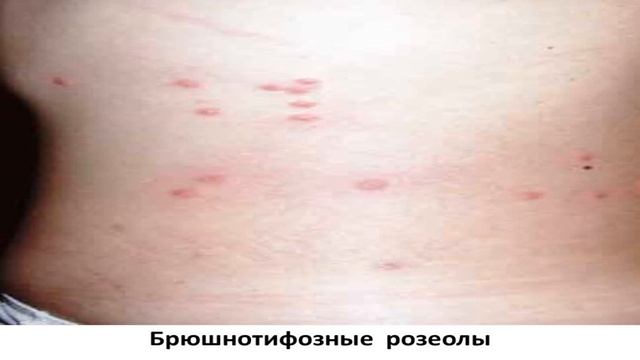 клиника  брюшного тифа