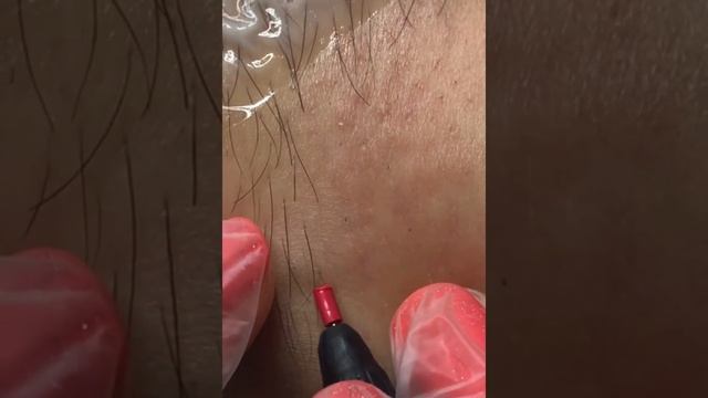 Электроэпиляция. Голень. видео