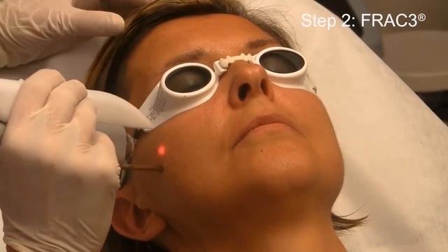 Fotona 4D - laserowy lifting twarzy w Klinice Tazbir w Łodzi