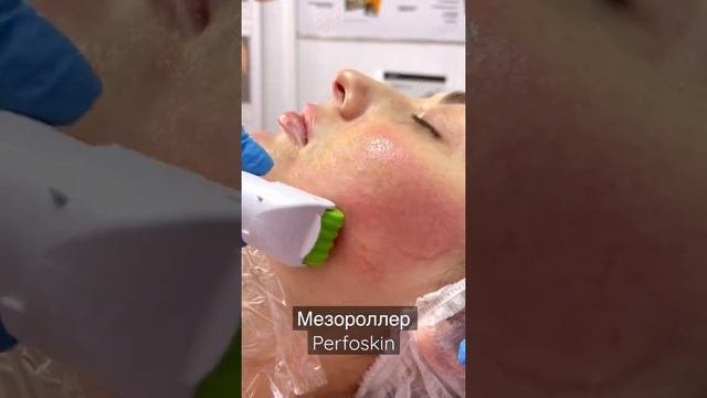 Мезороллер Perfoskin
