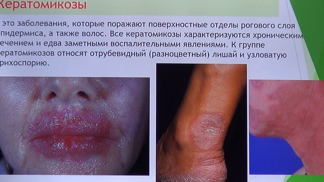 Грибковые заболевания микозные заболевания человека и влияние Webwellness на лечение