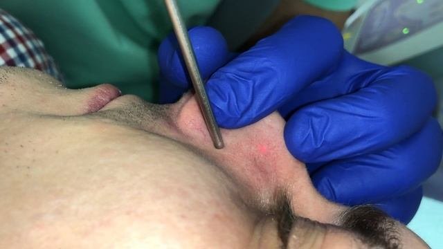 Лазерное удаление сосудов на лице