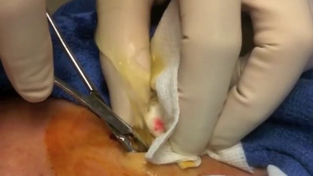 Seroma aspiration  drain insertion after lymph node excision