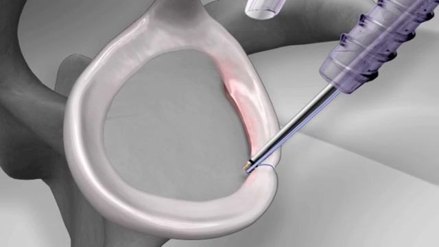 Knotless Shoulder Labral Repair with Arthrex® PushLock®