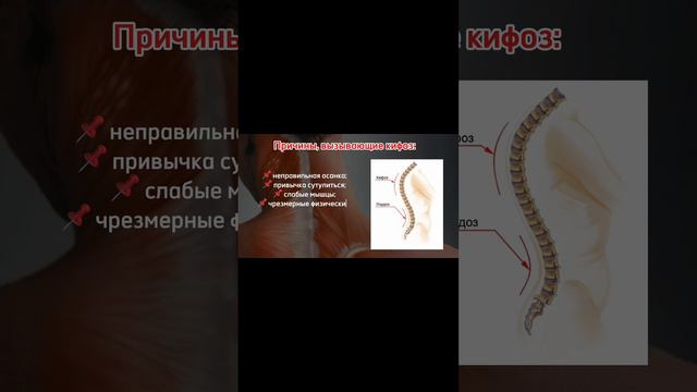 Кифоз. Причины простым языком