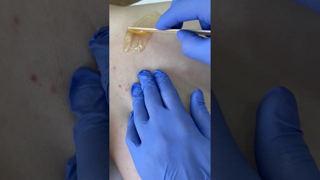 Эпиляция сахарной карамельной пастой и шугаринг спины в центре эпиляции Софт Эпил в Екатеринбурге