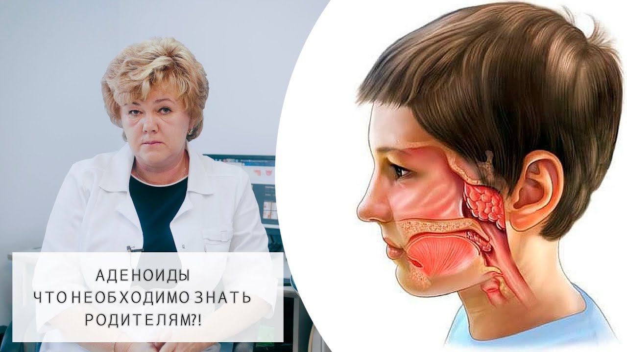 АДЕНОИДЫ  Что необходимо знать родителям?!