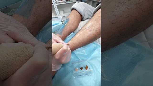 Убрали пятна витилиго без лекарств