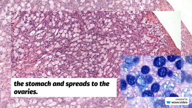 Metastatic krukenberg tumor