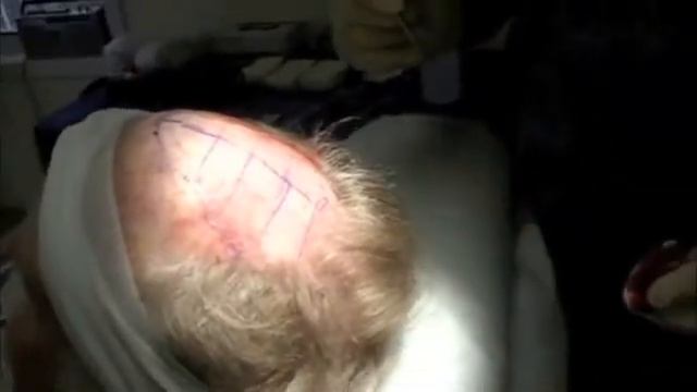 The Quest for Hair - Dr. William Lindsey