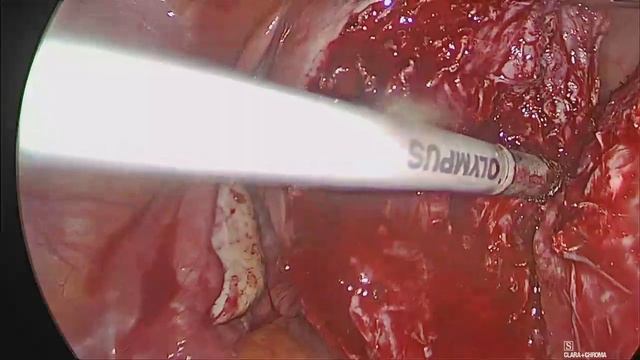Laparoskopik myomektomi, Laparoscopic myomectomy, Laparoscopic excision of uterine fibroids
