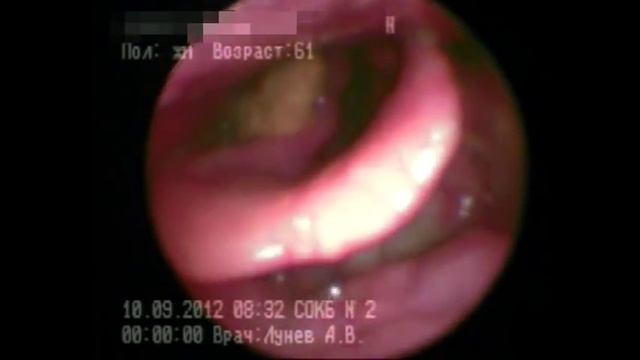 Рак гортани, выявленный на ранней стадии. Фиброларингоскопия.