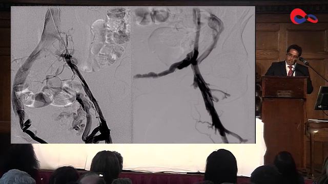 Post thrombotic syndrome- Intervention