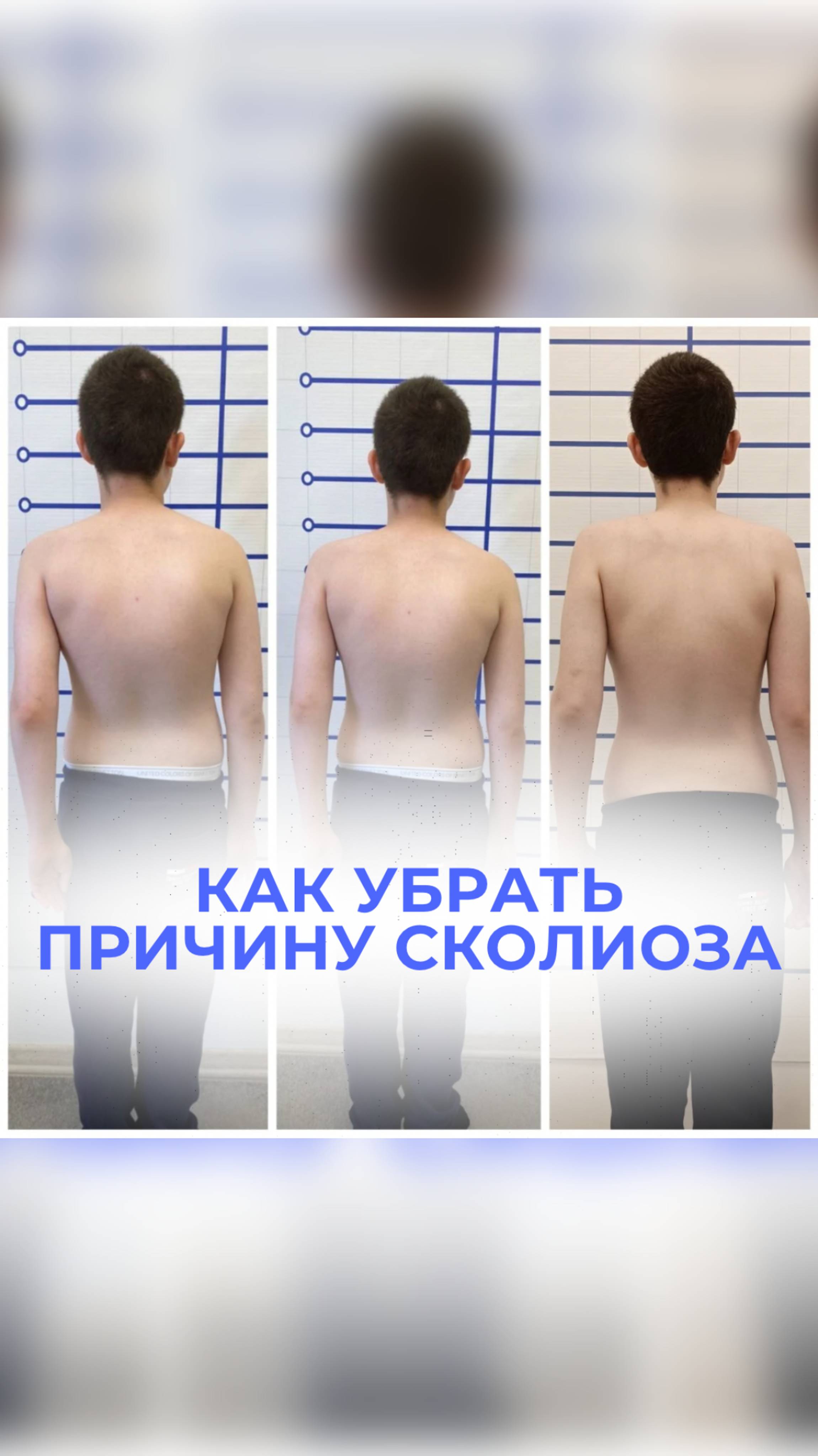 Как убрать причину сколиоза?