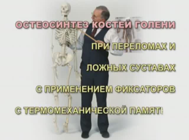 Остеосинтез костей голени при переломах и ложных суставах с применением фиксаторов с памятью формы