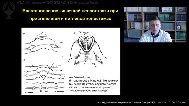 Хирургическая реабилитация больных с временными дигестивными стомами. Муратов А.А