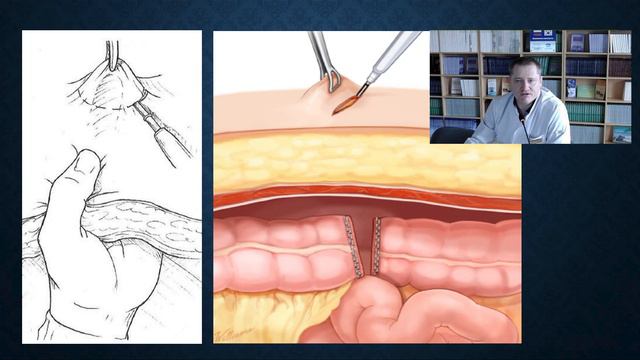 Техника формирования кишечной стомы. Медведников А.А.
