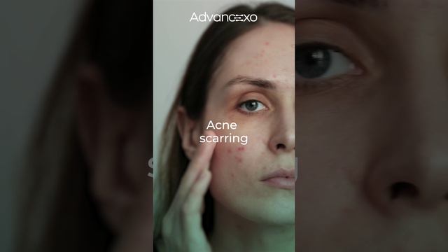 #Microneedling and #Advancexo #Exosomes: The Ultimate Skin Rejuvenation Duo!
