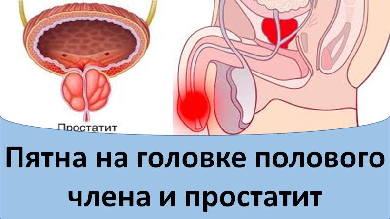 Пятна на головке полового члена и простатит