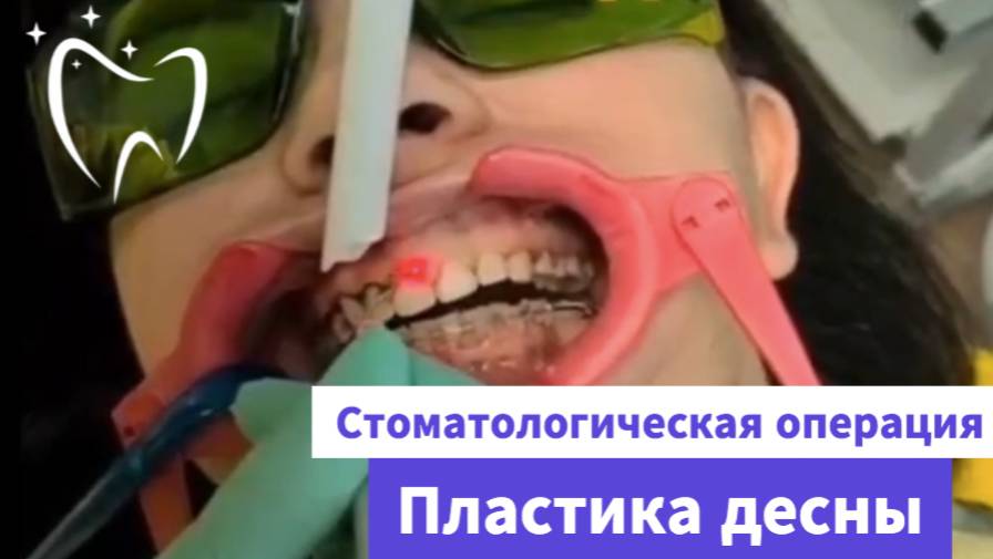 📽 Пластика десны: как проходит операция?