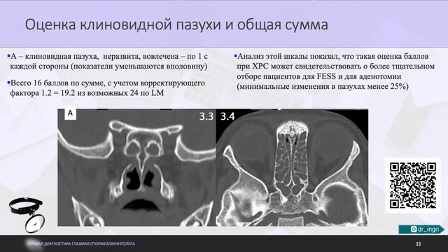 Лучевая диагностика. Хронические риносинуситы