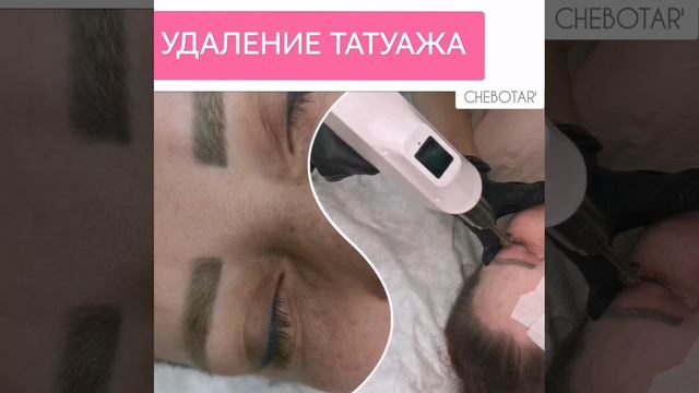 УДАЛЕНИЕ ТАТУАЖА | ЛАЗЕР, РЕМУВЕР ЭЖВА