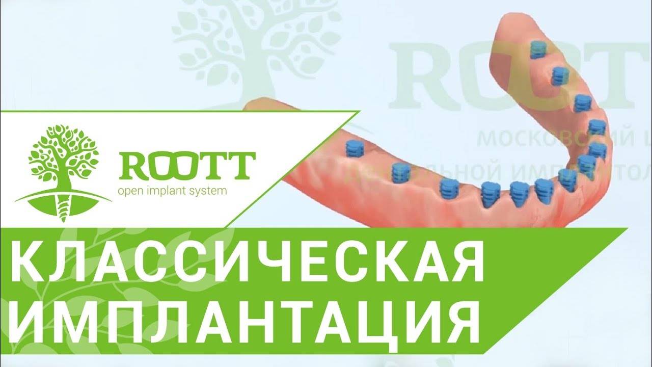 Имплантация на нижней челюсти. 👄 Классическая имплантация зубов на нижней челюсти. ROOTT.