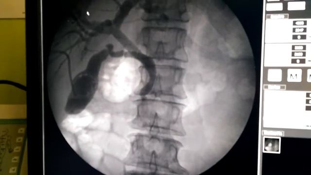 x-ray.Pancreatic cancer/Рак поджелудочной железы.