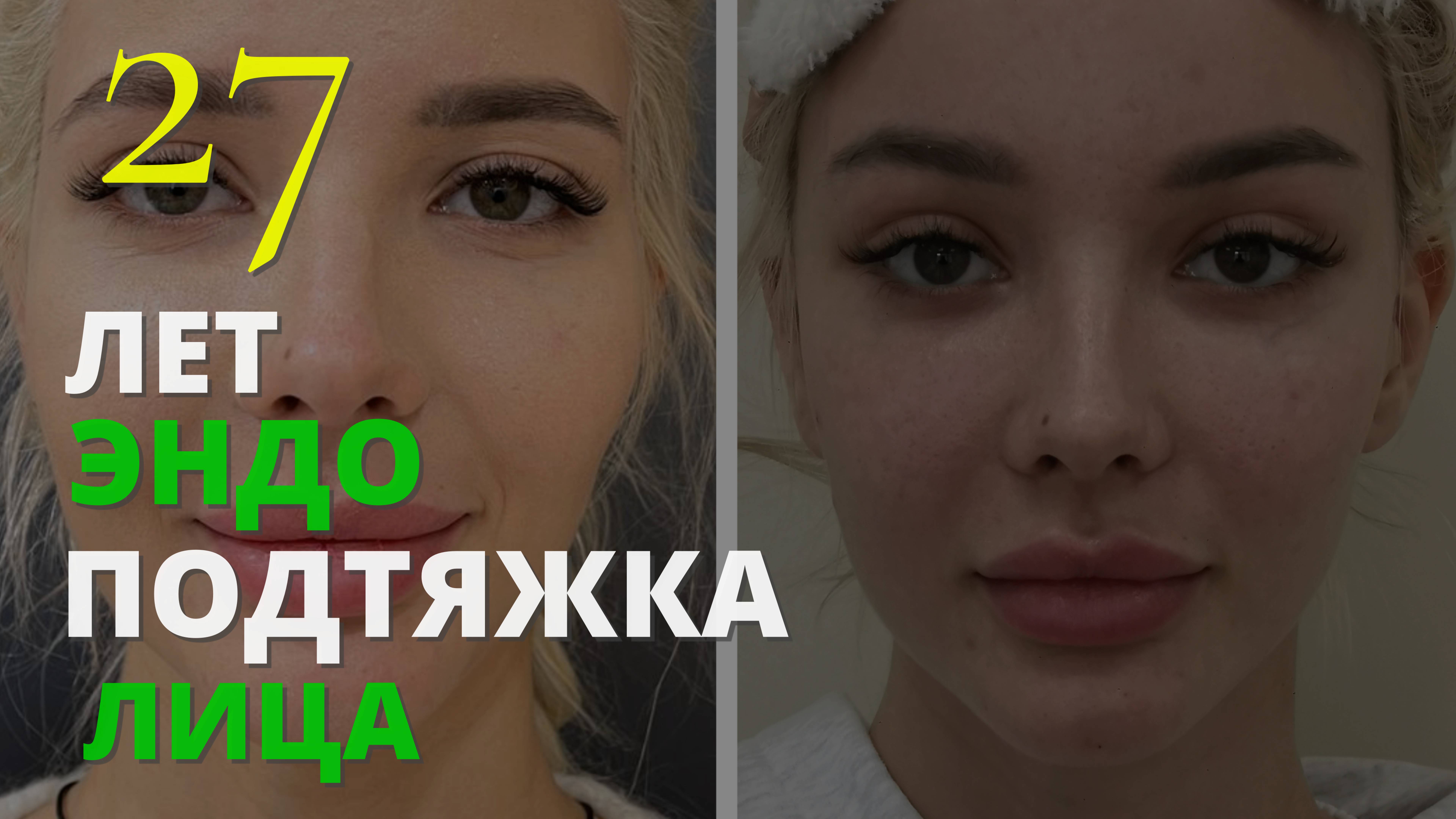 Подтяжка лица в 27 лет???! Не спешите с осуждением! Посмотрите на результат...