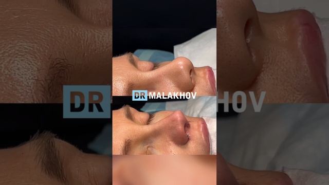 Первичная риносептопластика 🔥😍

Как вам такое ДО/ПОСЛЕ? 👀