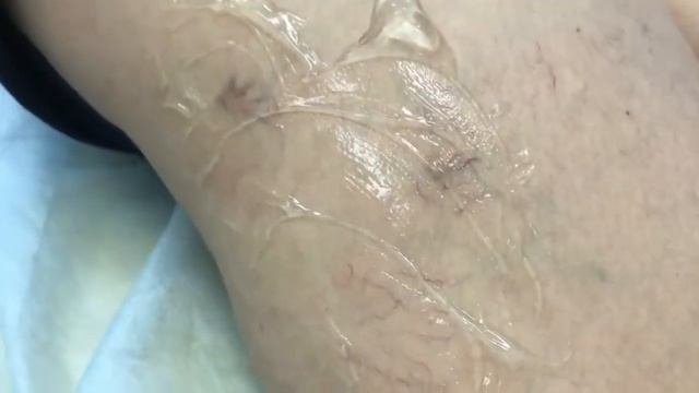Удаление сосудистых звездочек на лазере Cutera XEO в клинике "Консилиум"