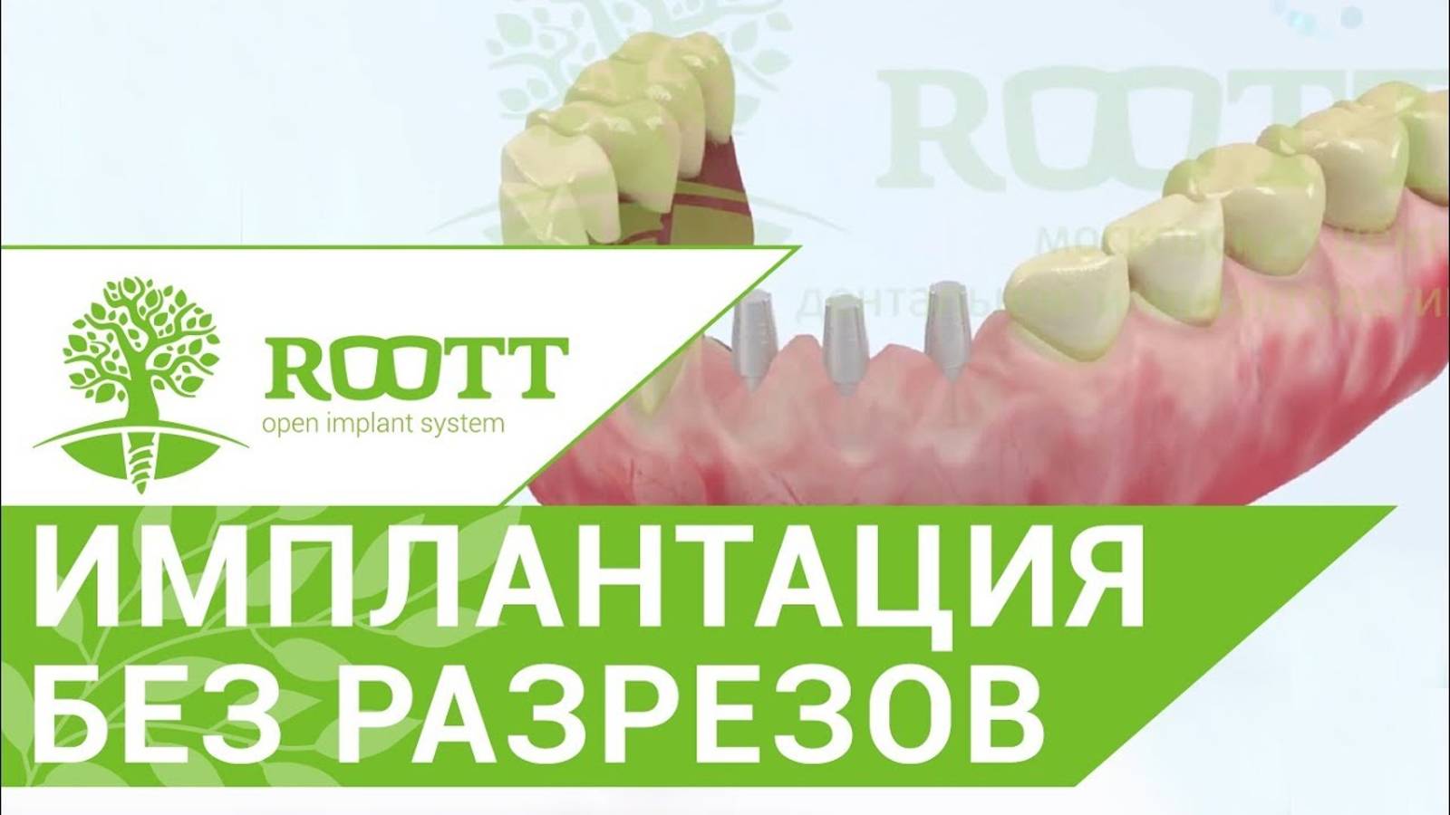 Экспресс имплантация. ⌛ Самый быстрый метод восстановления зубов с экспресс имплантацией.