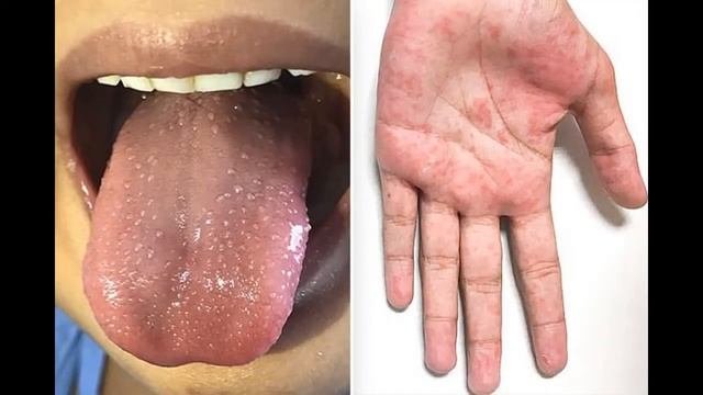 Синдром Кавасаки.  Последние новости. Kawasaki Syndrome. Last news.
