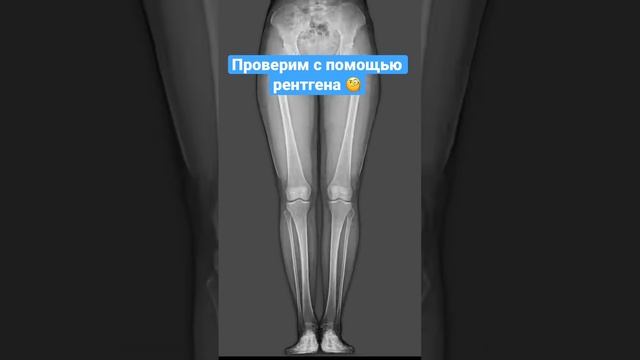 Влияет ли полнота на форму ног? Эксперимент. #похудеть #жиранет #неткривизненог #варус #ножки