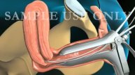 Как делают пайпель биопсию эндометрия 3D анимация, англ