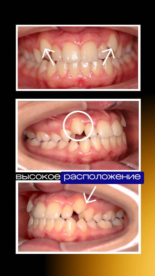 Брекеты с установкой, всего за один приём. Orthometric Ultra-P