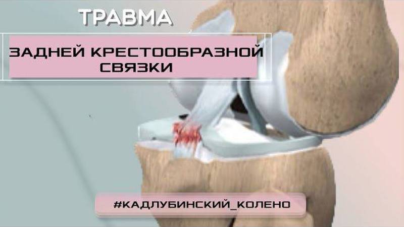 Что делать, если у вас травма задней крестообразной связки?