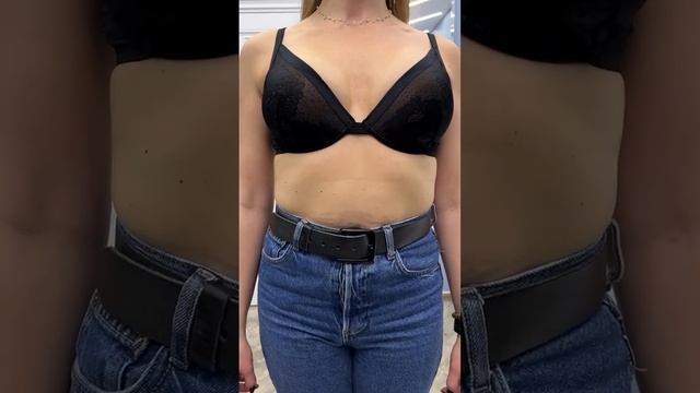 Результат увеличения груди - 3 размер! 🔥