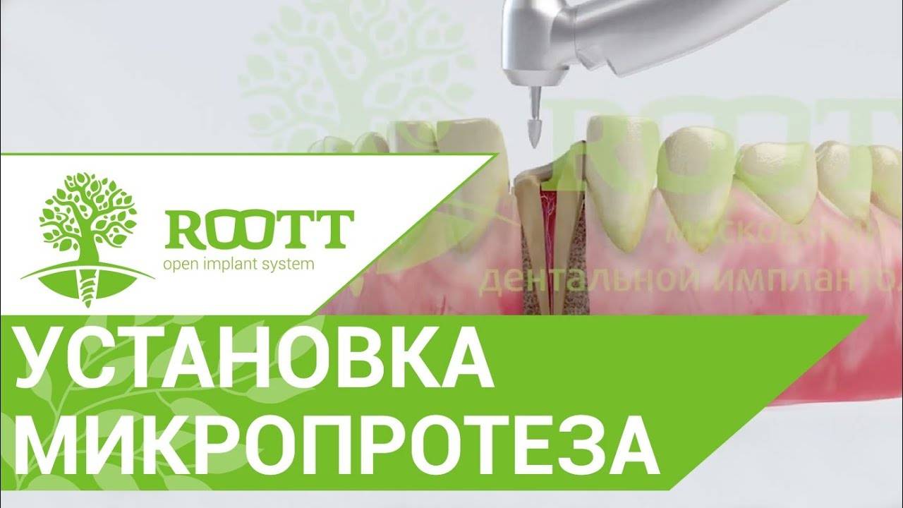 Микропротезирование зубов. 🔬 Микропротезирование зубов и культевая вкладка. ROOTT