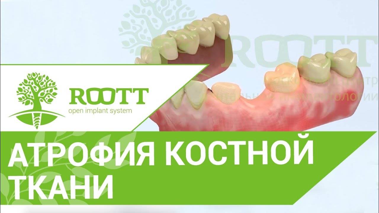 Атрофия костной ткани. 😨 Чем опасна атрофия костной ткани?Клиника ROOTT