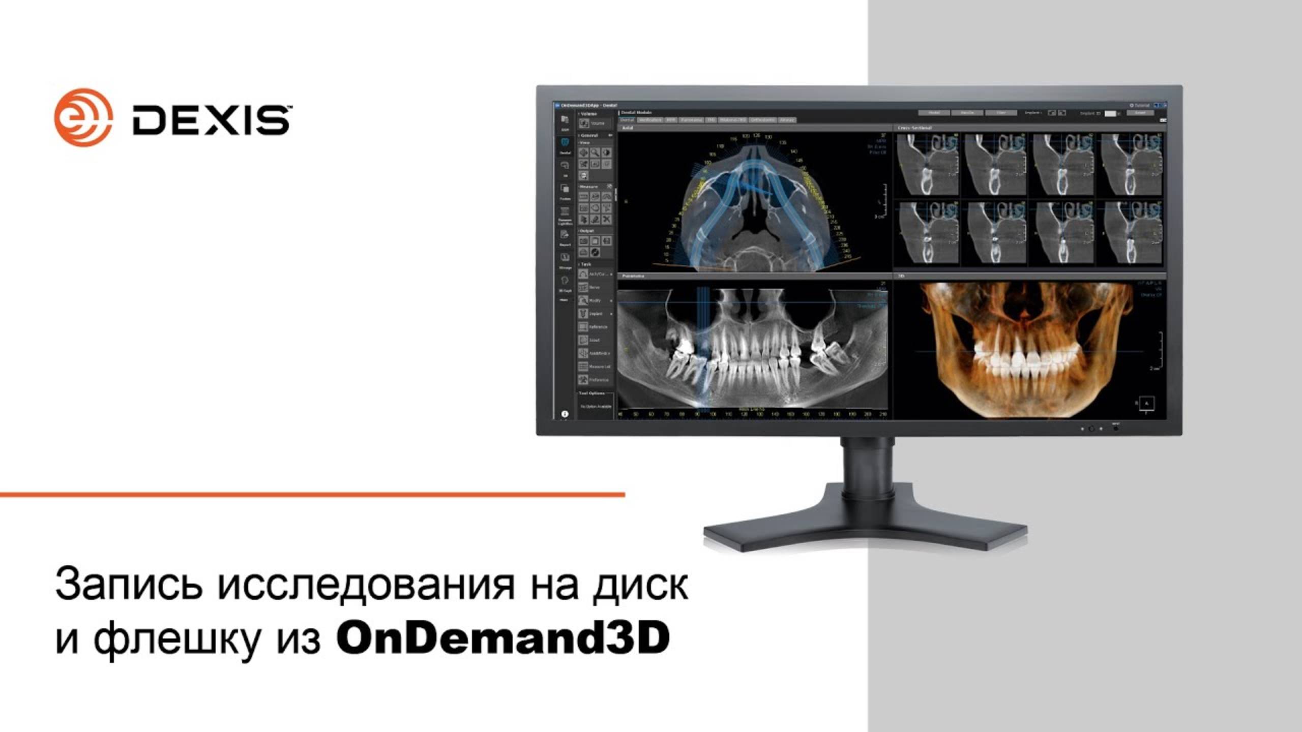 Запись исследования на диск и флешку из OnDemand3D | DEXIS Russia