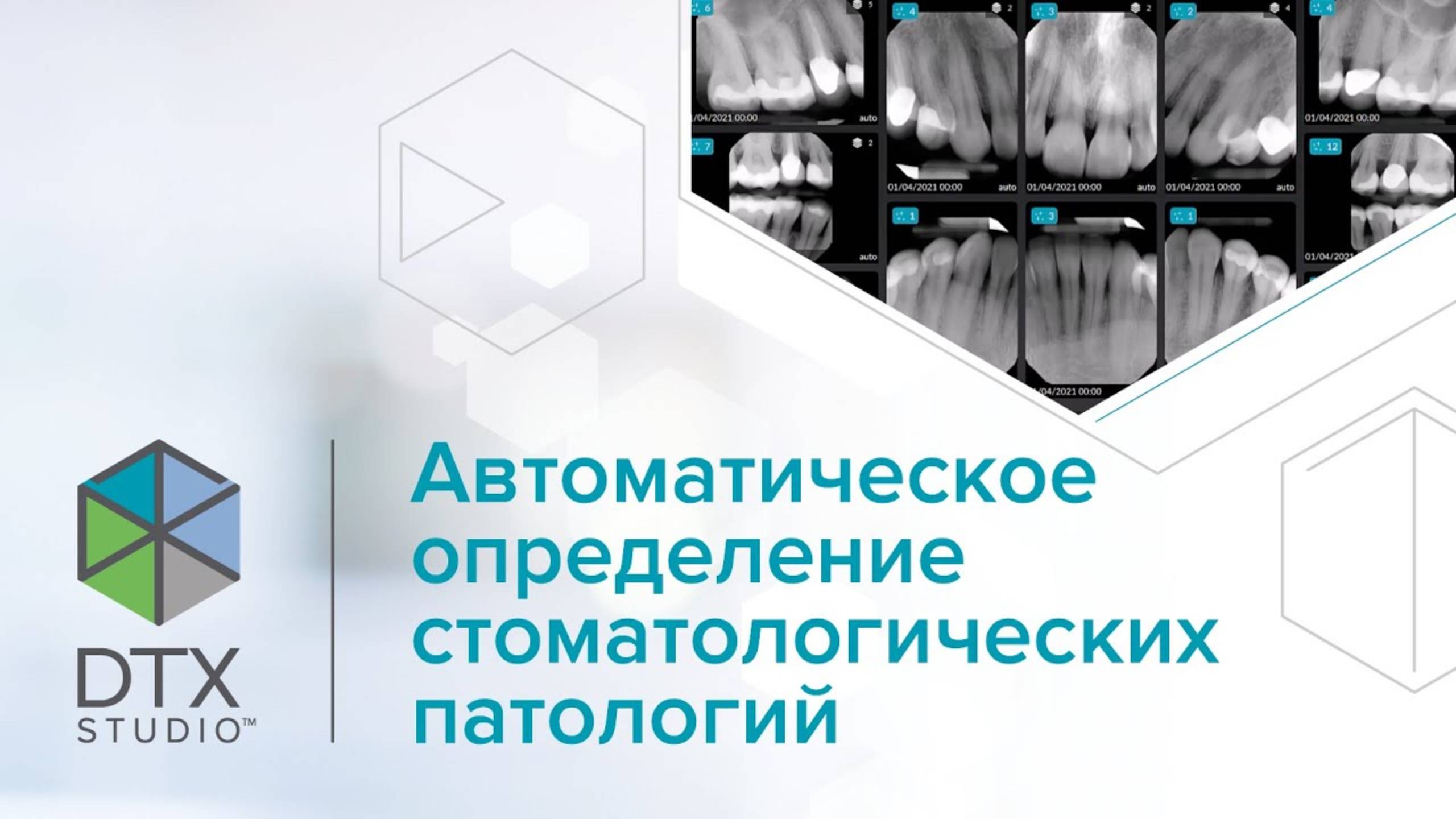 Автоматическое определение стоматологических патологий | DTX Studio Clinic