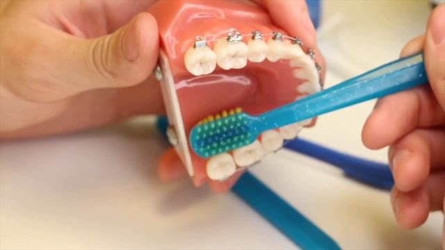 Как чистить зубы с брекетами? Рассказывает и показывает стоматолог Никита Александрович Дроздецкий