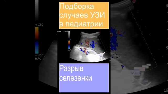 Подборка случаев УЗИ в педиатрии