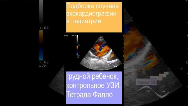 Подборка случаев эхокардиографии в педиатрии