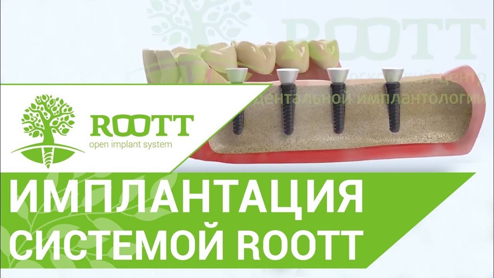 ROOTT имплантация. Система имплантации клиники ROOTT