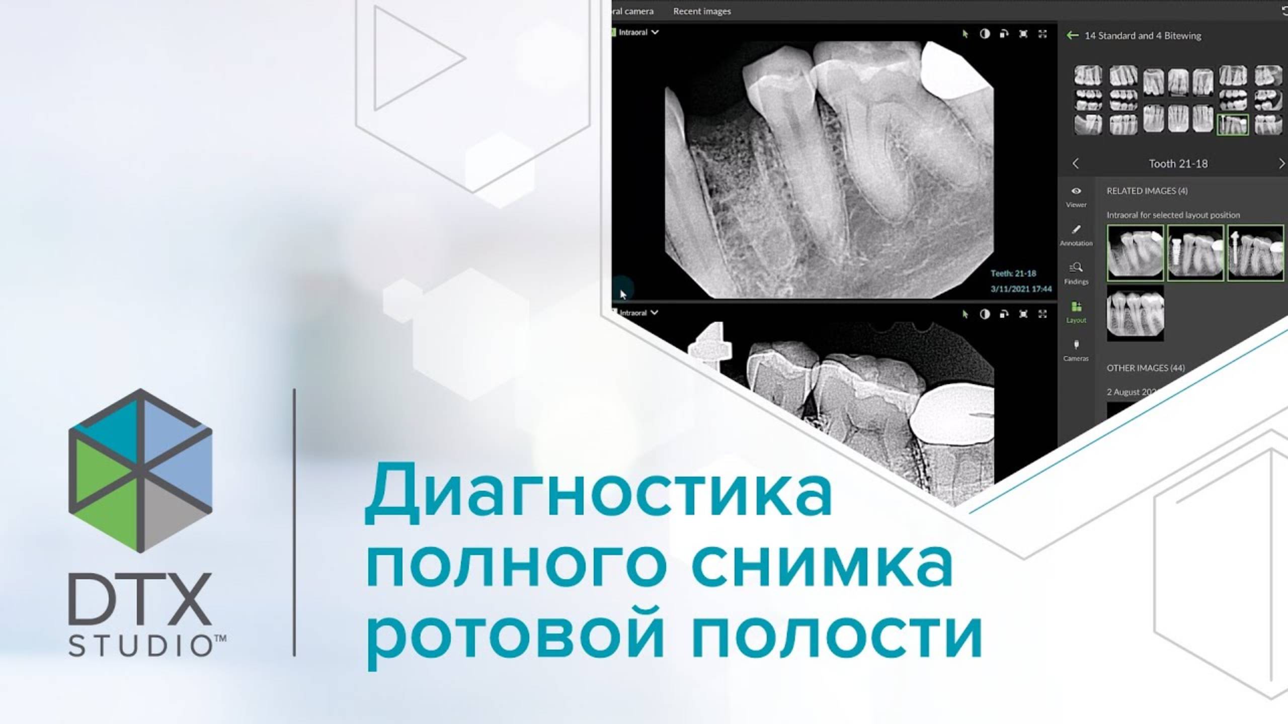 Диагностика полного снимка ротовой полости | DTX Studio Clinic