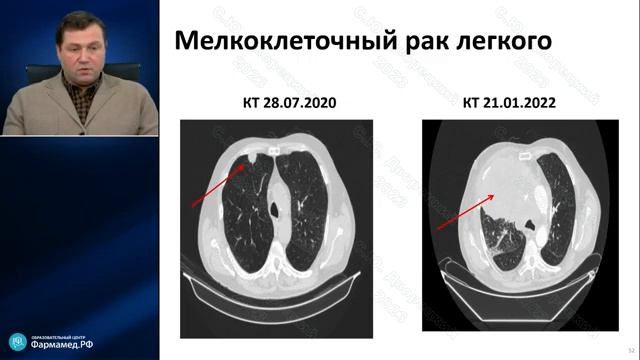 Рак легкого. Часть 1 (проф. Дворецкий С.Ю.)